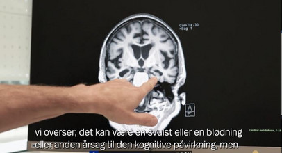 Professor og overlæge Steen Hasselbalch fra Hukommelsesklinikken på Rigshospitalet fortæller om udredning for Alzheimers sygdom